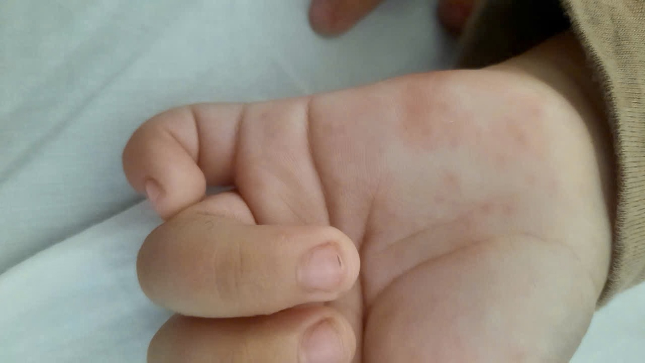 TP HCM Trẻ dưới 9 tháng tuổi mắc sởi có dấu hiệu gia tăng