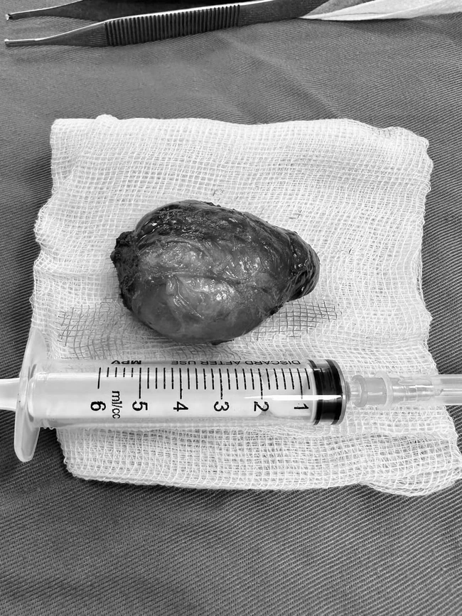 Nữ sinh viên đeo khối u khổng lồ trước cổ, chèn đường thở suốt 4 năm