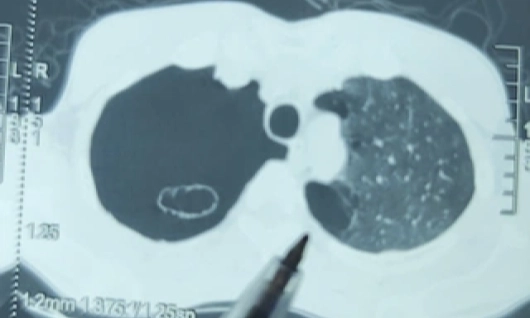 Thủng phổi sau khi hút cả bao thuốc lá mỗi ngày
