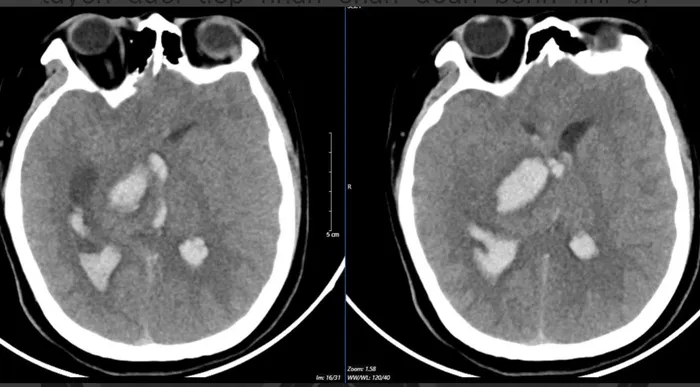 Bé 15 tuổi tử vong sau cơn đau đầu đột ngột