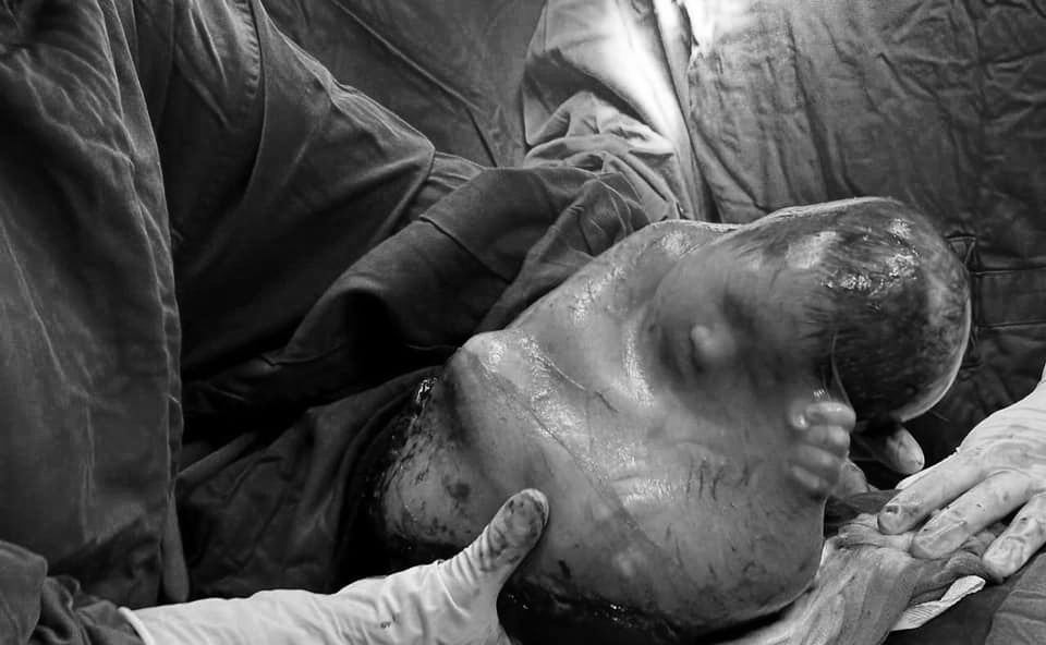 Bé trai đẻ bọc điều , 80 000 ca mới có một