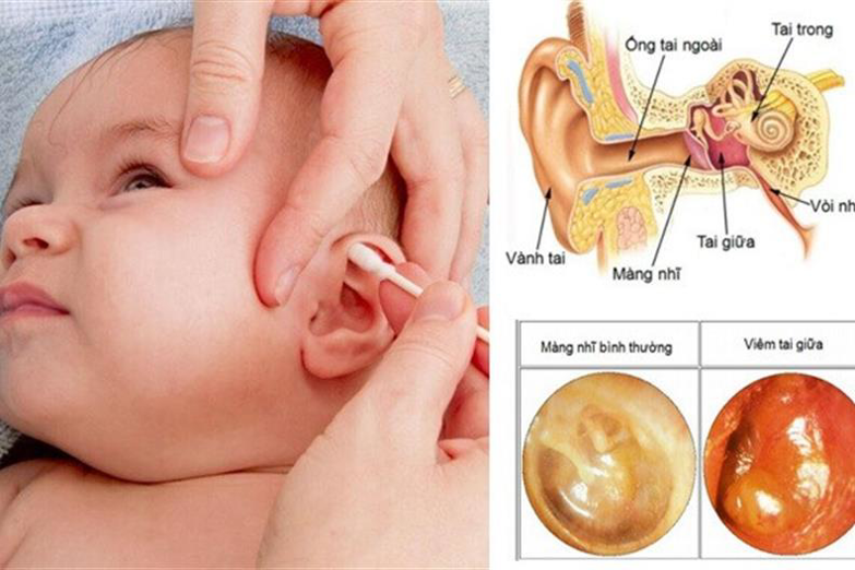 Thuốc điều trị viêm tai giữa do bệnh sởi