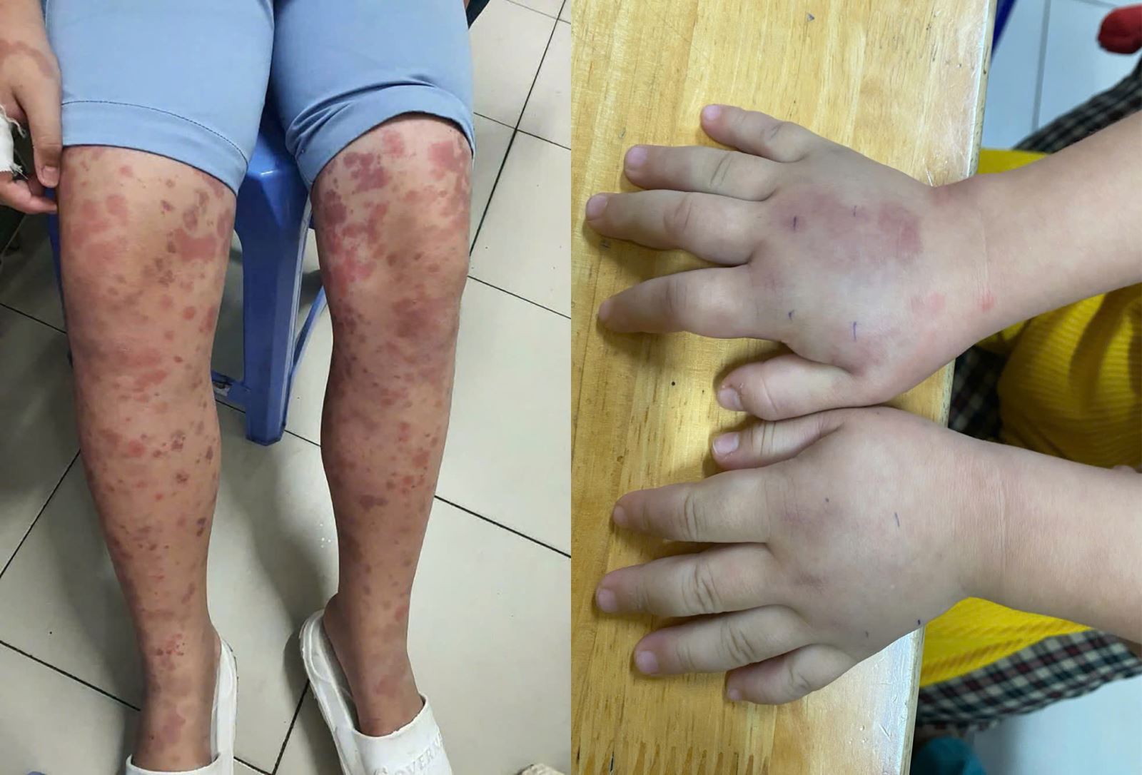 Bác sĩ cảnh báo biến chứng thận nguy hiểm ở trẻ bị ban xuất huyết Schonlein-Henoch