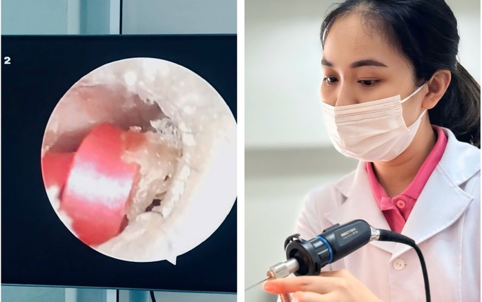 Bé gái 6 tuổi suýt thủng màng nhĩ do dây buộc tóc nằm sâu trong tai