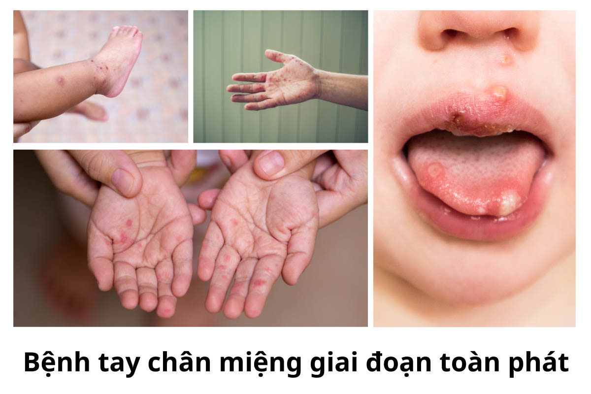 Gia tăng ca mắc tay chân miệng, dấu hiệu cha mẹ cần lưu ý