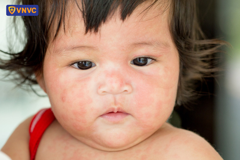 Cảnh báo Trẻ em sốt phát ban – những dấu hiệu nhận biết sớm, cha mẹ không được chủ quan
