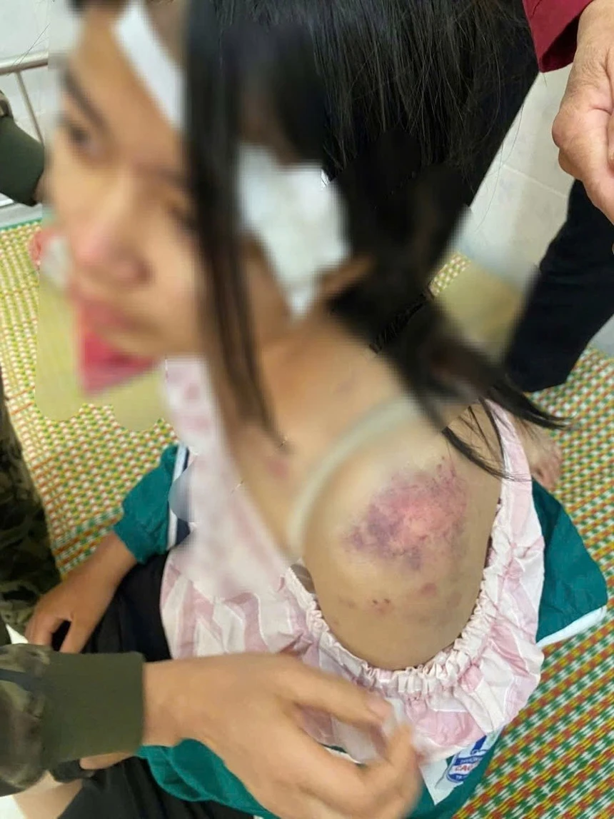 Bé gái 13 tuổi bị bà và 2 người ông đánh đập dã man vì nghi trộm tiền