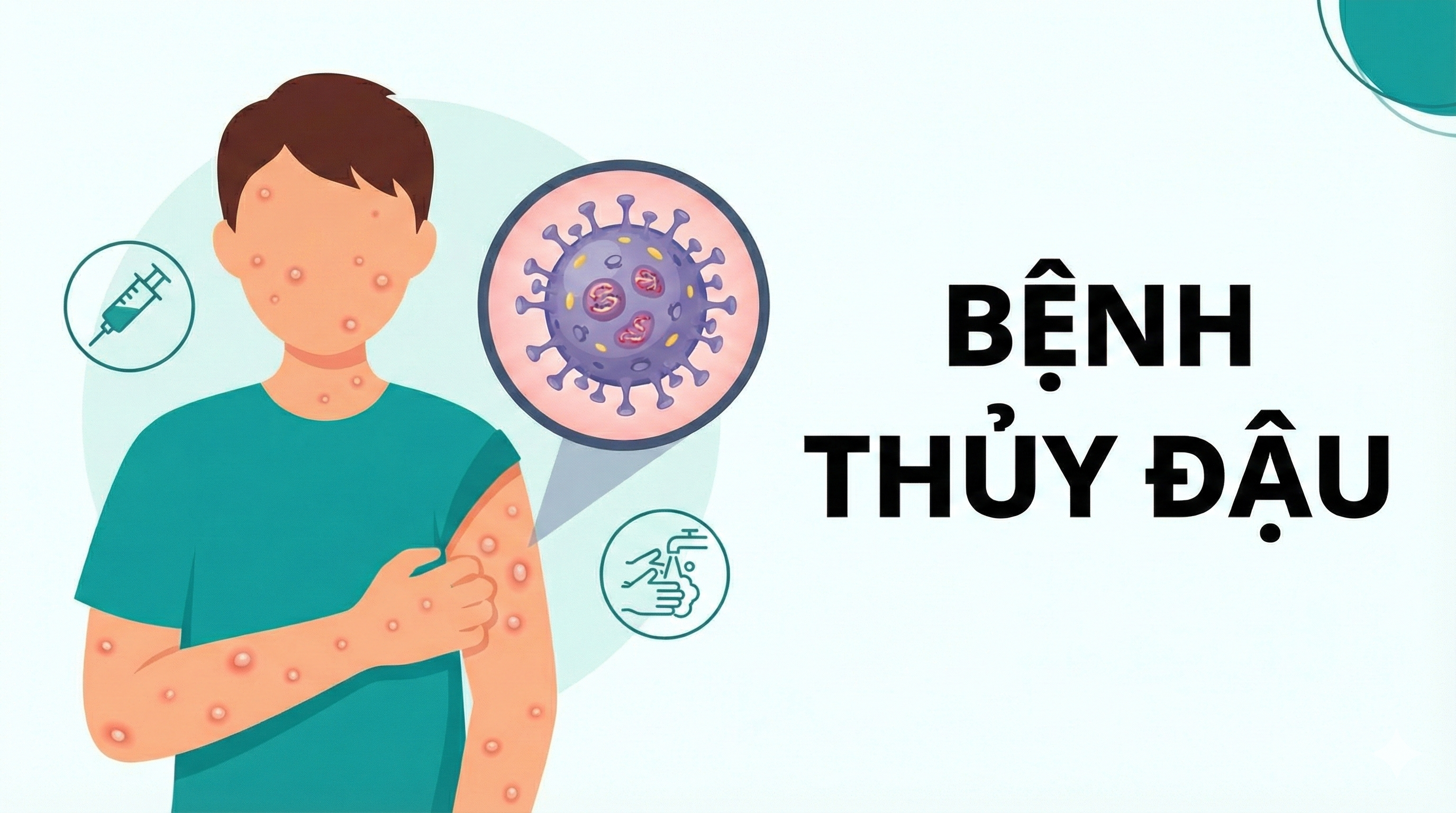 Bệnh thủy đậu Biến chứng khôn lường và phác đồ chăm sóc chuẩn