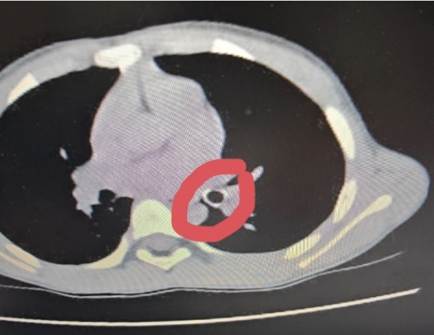 Thói quen khiến bé trai phải đi cấp cứu khi đang học bài