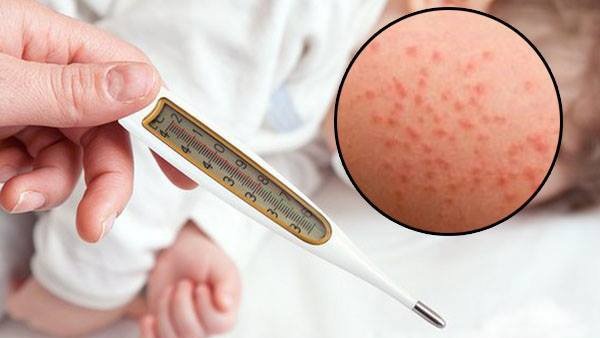 Bộ Y tế ban hành hướng dẫn mới nhất về chẩn đoán và điều trị bệnh sởi