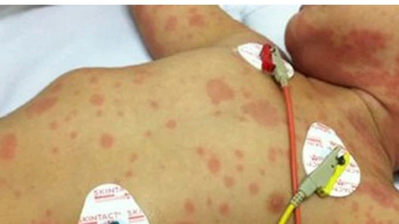 Cảnh báo nguy cơ viêm màng não mô cầu lan rộng