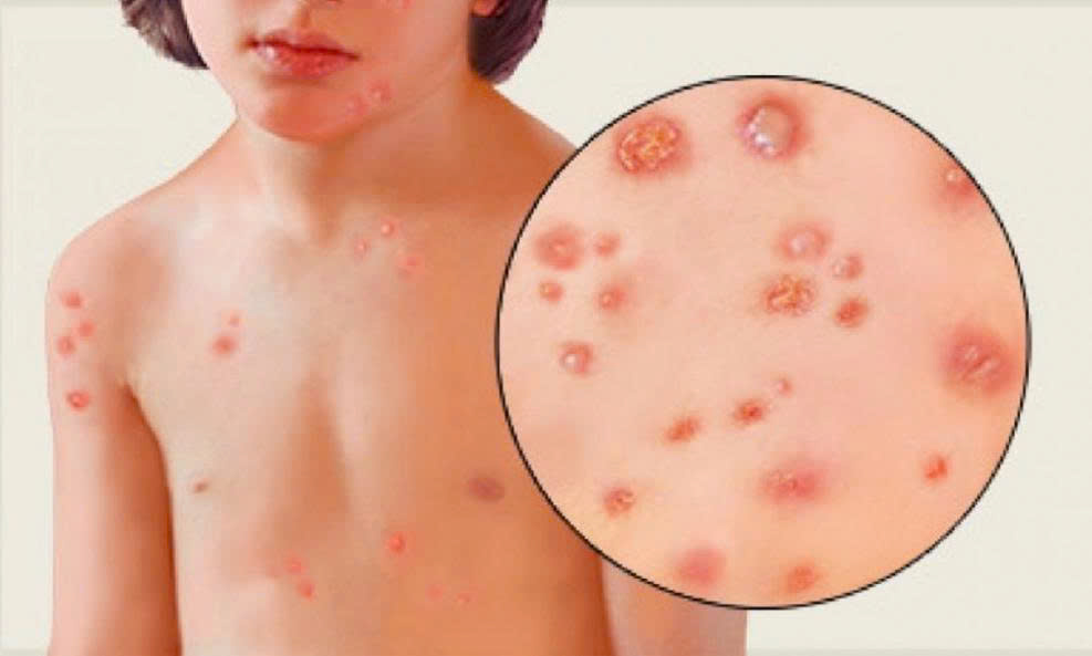 Đắk Lắk Triển khai cấp thuốc tận nhà, dập ổ dịch thủy đậu tại xã Ea Riêng