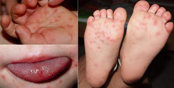 Hà Nội Ghi nhận 179 ca mắc tay chân miệng trong tuần