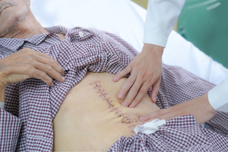 “Quả bom hẹn giờ” ở người bệnh cao tuổi - Phình động mạch chủ bụng