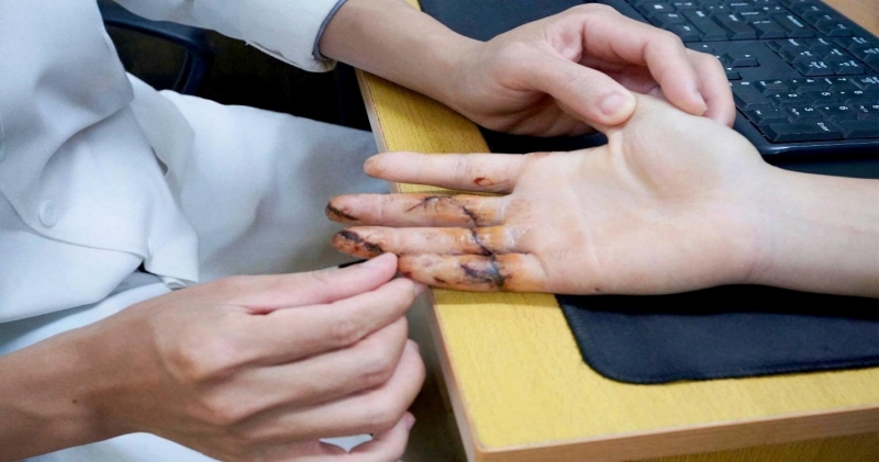 Cuộc vi phẫu 10 giờ giữ lại 3 ngón tay gần đứt lìa cho chàng trai 17 tuổi