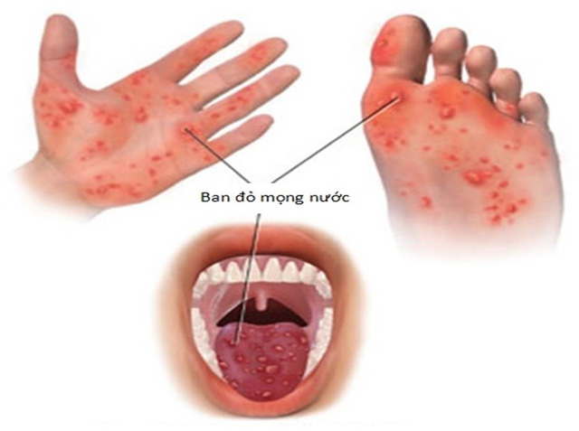 Bộ Y tế khuyến cáo khẩn về phòng bệnh tay chân miệng
