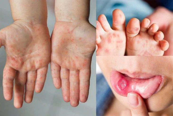 Dịch bệnh Tay chân miệng tại TP HCM tăng đột biến