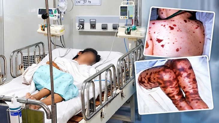 Phân biệt não mô cầu với sốt xuất huyết