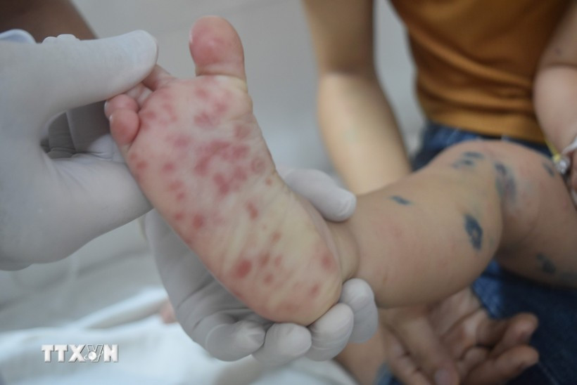 Hand, foot and mouth cases increase five-fold in Q1